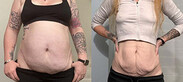 Lucy’s Mounjaro weight loss journey with type 1 diabetes – 130lbs lost and insulin levels improved